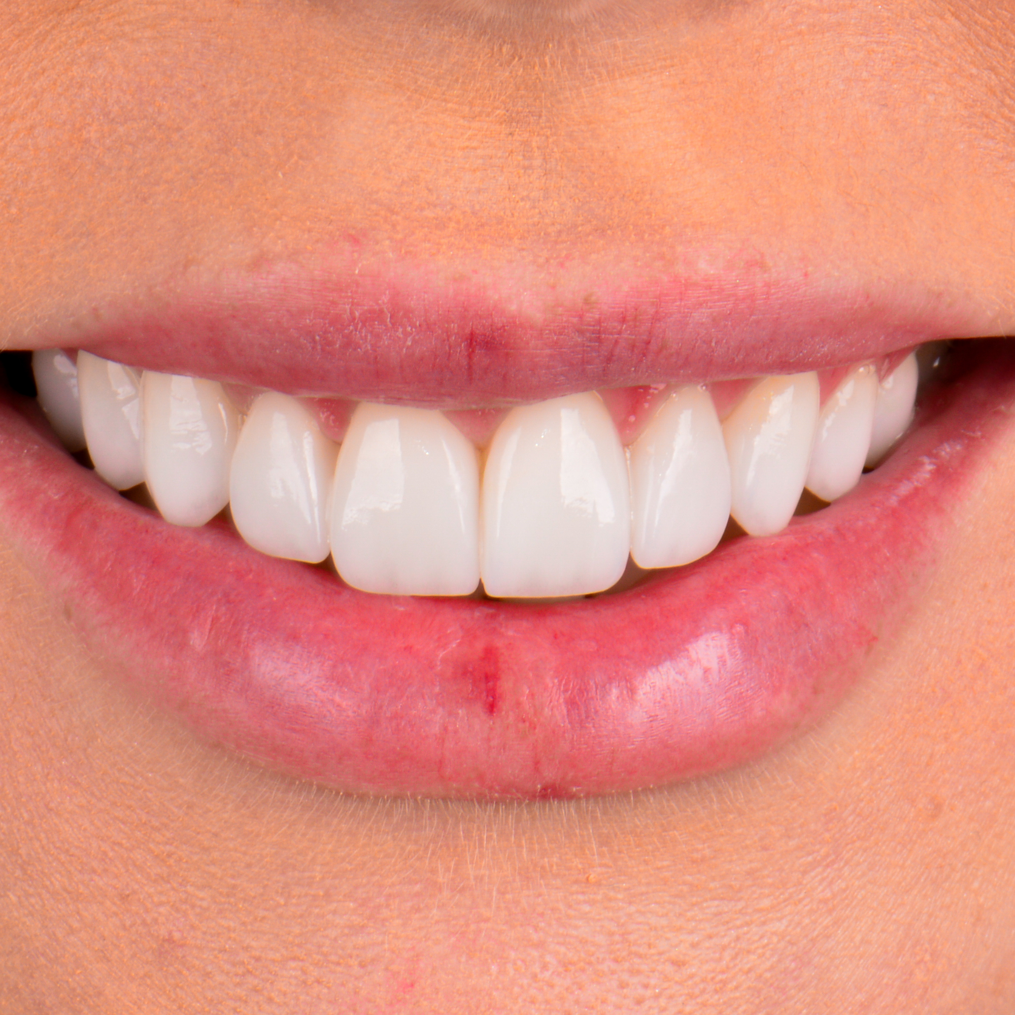 Provisórios de Alta Performance