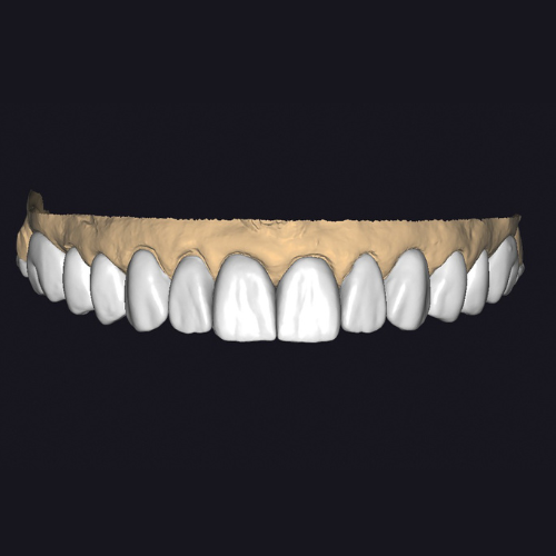 Enceramento Digital​